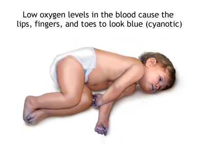 cyanosis in heart