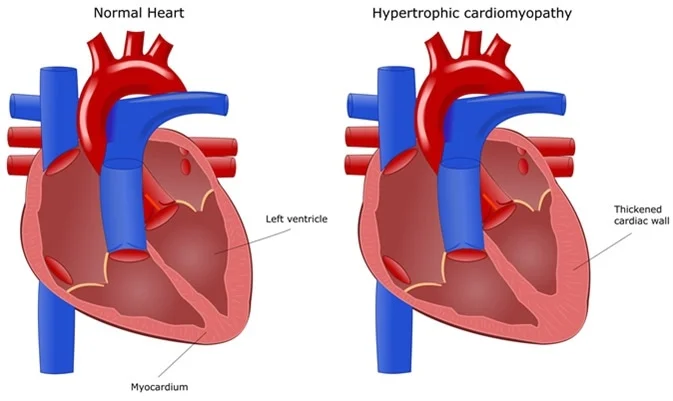 Genetics of Hypertrophic Cardiomyopathy: