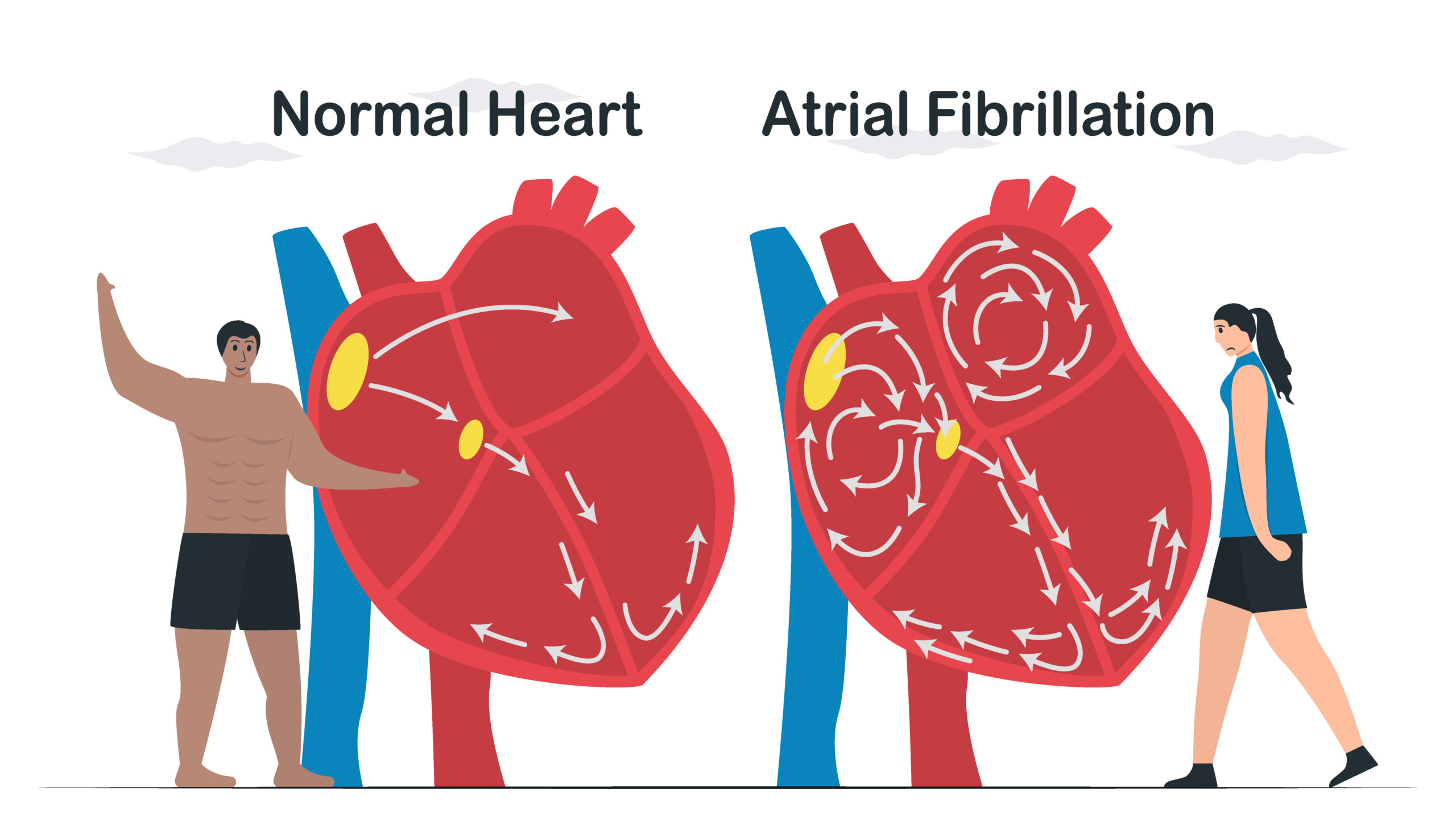 2024 ESC Guidelines for Management of Atrial Fibrillation - Cardio Blogger