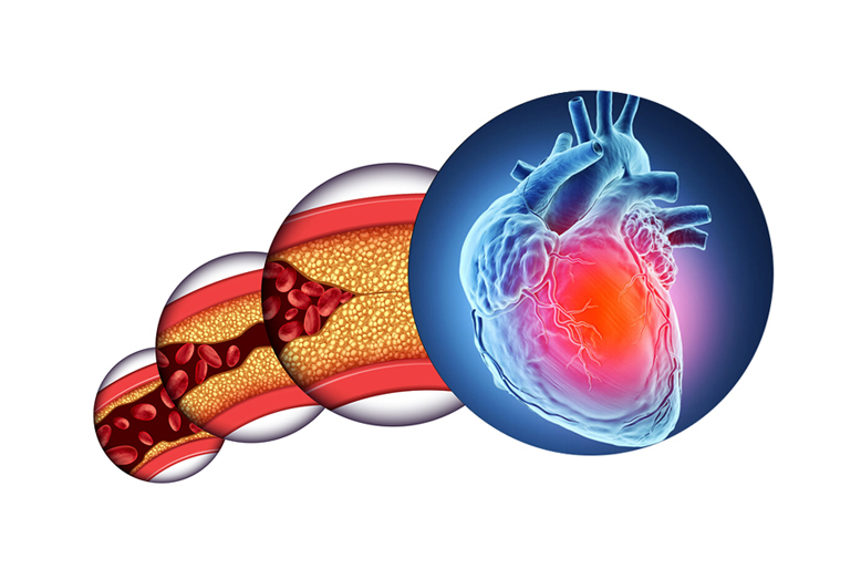 Lipoprotein(a) and Cardiovascular Disease: Key Points